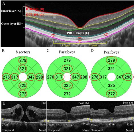 oct macular thickness measurements|abnormal macular thickness.